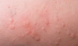 hives-1