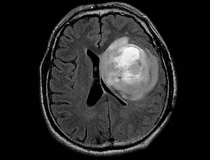 brain-tumor-removal