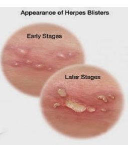 Herpes Percentage
